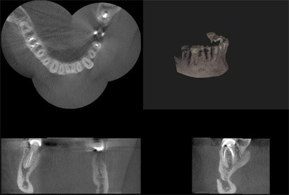 Dental Implant Hospital In Delhi, Dental Implant Hospital In India