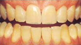 Teeth Whitening Gallery - Teeth whitening costs, Zoom teeth whitening, Laser Teeth Whitening In Delhi