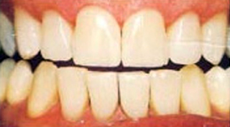 Teeth Whitening Gallery - Whitening the teeth, Tooth Whitening, Teeth Whitening