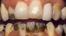 Teeth Whitening Gallery - Tooth Whitening, Teeth Whitening, Teeth whitening costs