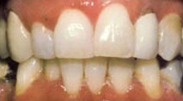 Teeth Whitening Gallery - Teeth Whitening, Teeth whitening costs, Zoom teeth whitening