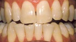 Teeth Whitening Gallery - Tooth Whitening, Teeth Whitening, Teeth whitening