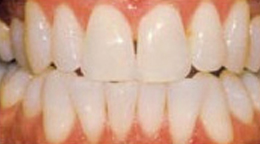 Teeth Whitening Gallery - Zoom teeth whitening, Laser Teeth Whitening In Delhi
