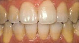 Teeth Whitening Gallery - Whitening the teeth, Laser Teeth Whitening In Delhi
