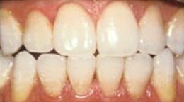Teeth Whitening Gallery - Whitening the teeth, Teeth whitening costs