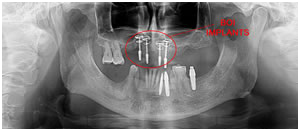 Teeth in an hour-BOI, Teeth in an Hour