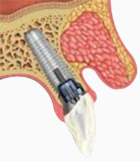 Dental Implants, One Piece Implants and Flapless, Dental Implants In Delhi