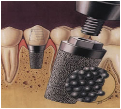 Endopore, Endopore Dental implants In Delhi, Endopore dental implants