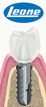 Leone Implant, Leone Dental Implants, Leone Exacone Dental Implants