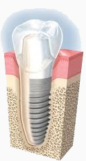Nobel Biocare Dental implants, Nobel Biocare
